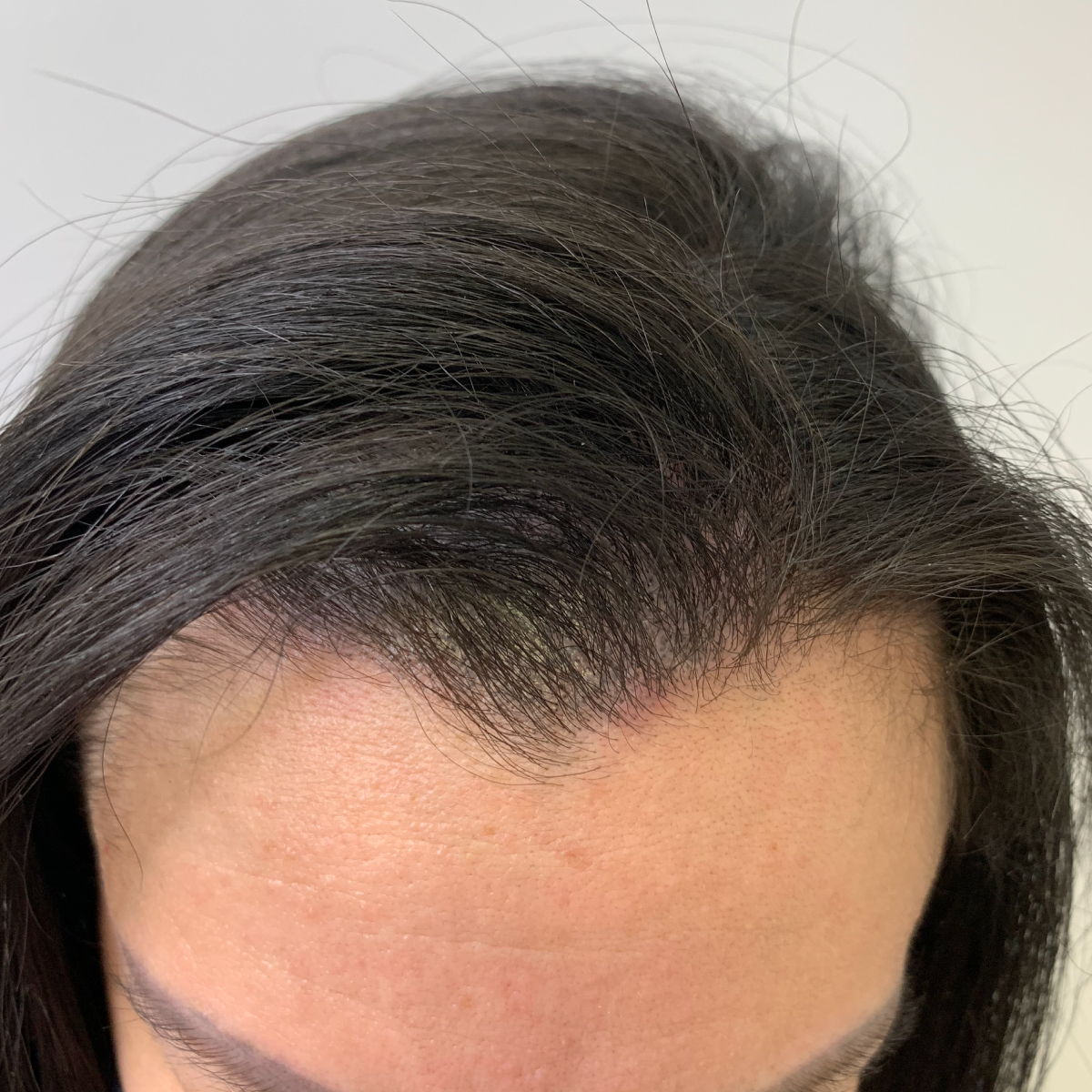 scalp-micropigmentation-discreet