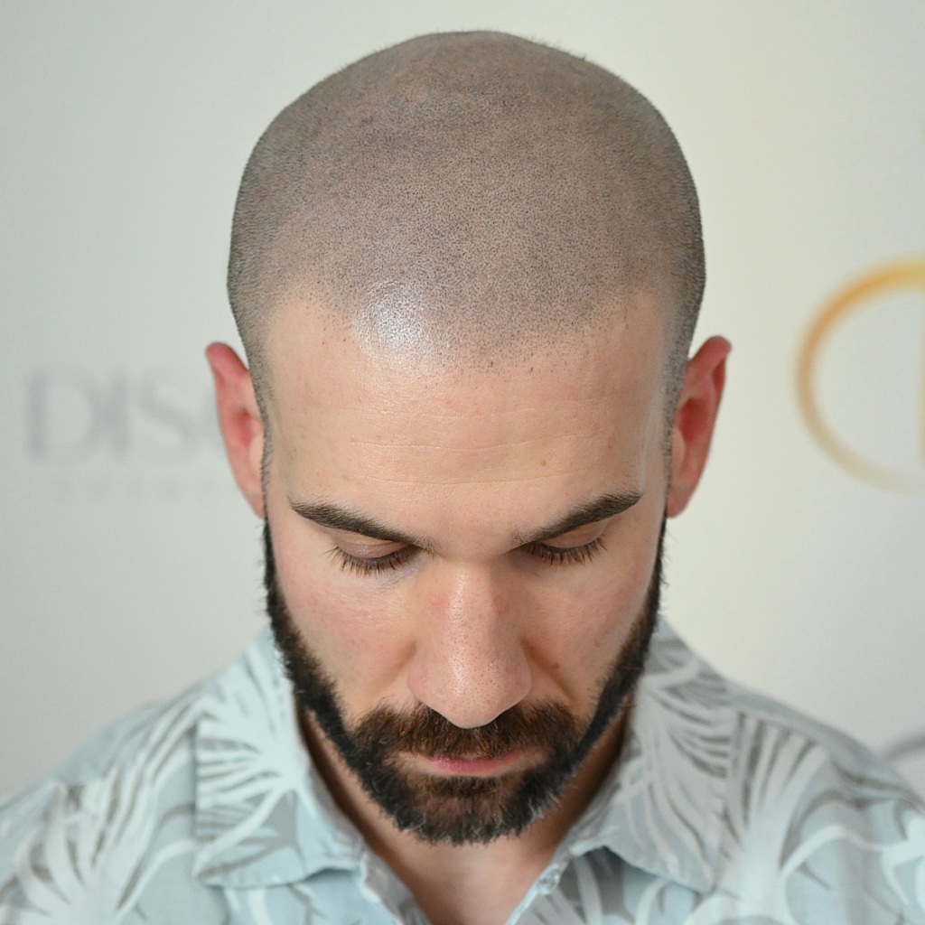 Discreet Cosmetic Studio | Scalp Micropigmentation