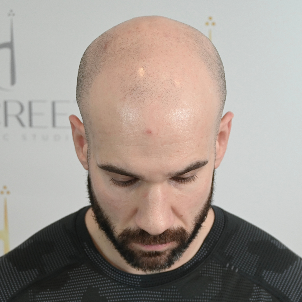 Discreet Cosmetic Studio | Scalp Micropigmentation