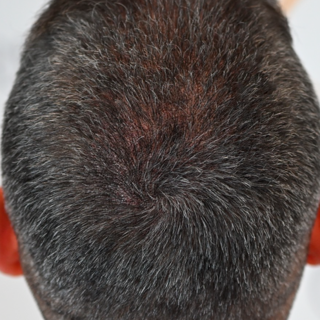 Scalp Micropigmentation Near Me