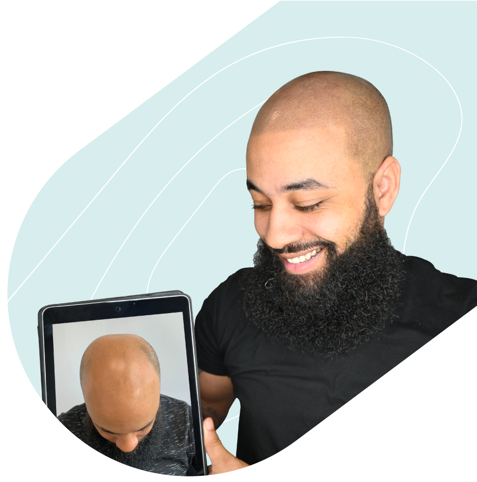 What Is SMP? | Scalp Micropigmentation