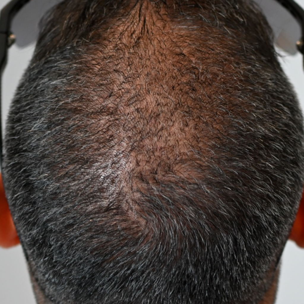 Scalp Micropigmentation