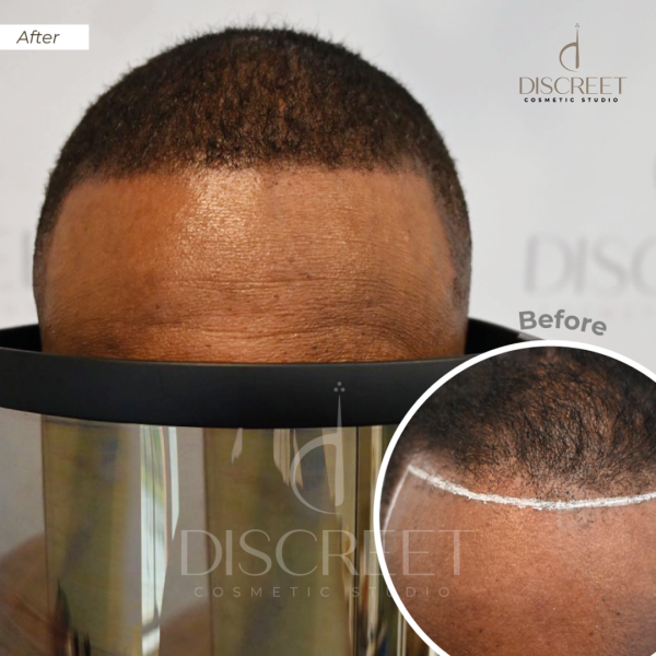 Scalp Micropigmentation | What You Should Know Before You Start