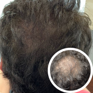 Scalp Micropigmentation Near Me