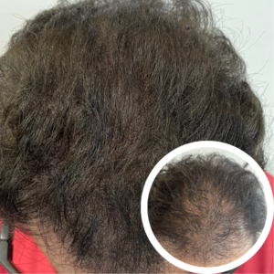 Scalp Micropigmentation Near Me