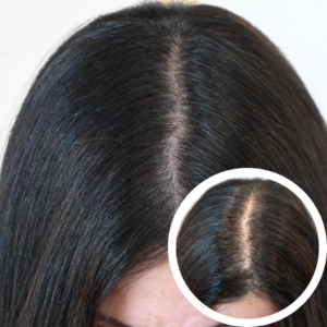 Scalp Micropigmentation For Women