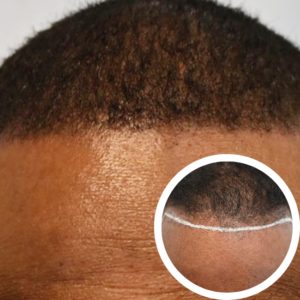 Scalp Micropigmentation Orlando