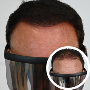 Scalp Micropigmentation Orlando