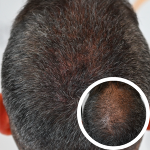 Scalp Micropigmentation Orlando