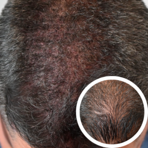 Scalp Micropigmentation Orlando