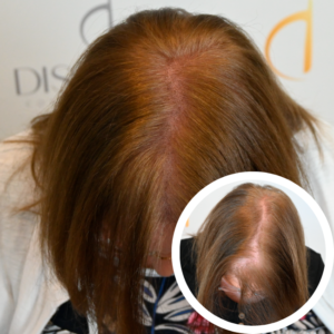 Scalp Micropigmentation For Women