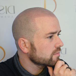 Benefits of Scalp Micropigmentation