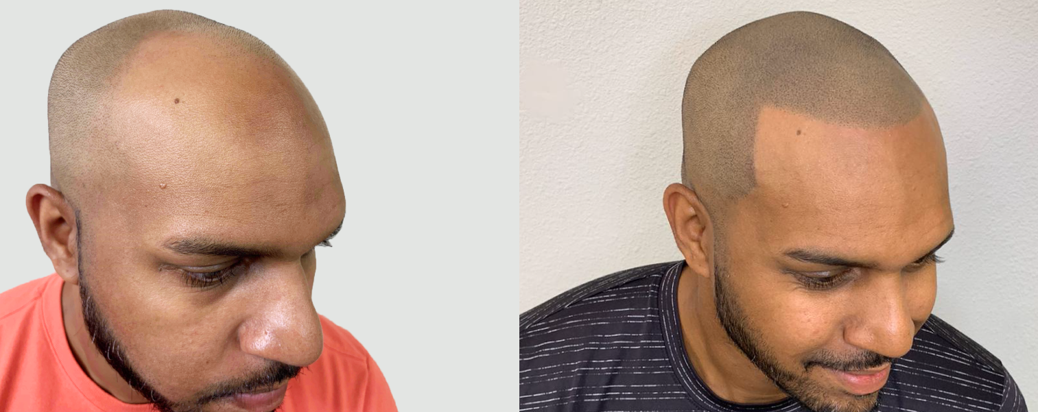 The Rising Trend of Scalp Micropigmentation
