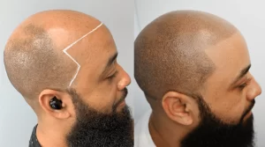 Scalp Micropigmentation