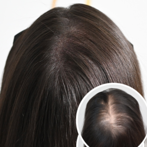 Scalp Micropigmentation SMP