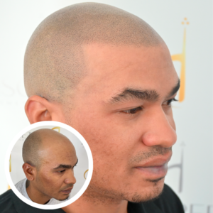 Scalp Micropigmentation Near Me | Discreet Cosmetic Studios