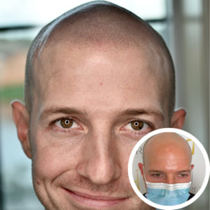 Scalp Micropigmentation Near Me | Discreet Cosmetic Studios