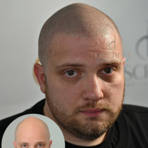 SMP Gallery Male Pattern Baldness