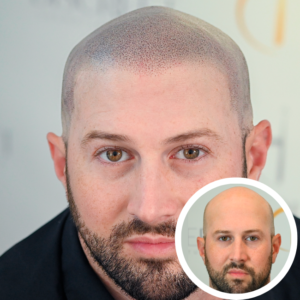 Scalp Micropigmentation Near Me | SMP Near Me