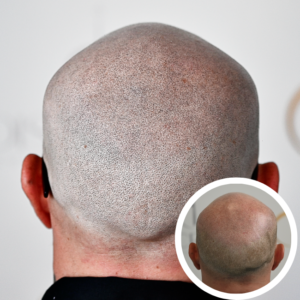 Scalp Micropigmentation Orlando | SMP Near Me