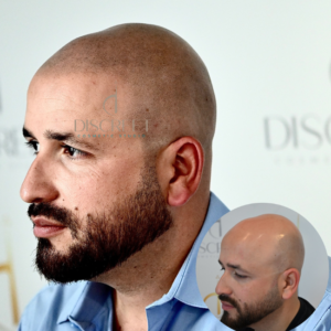 Scalp Micropigmentation Near Me