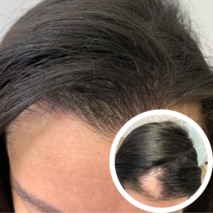 Scalp Micropigmentation SMP | SMP Cost