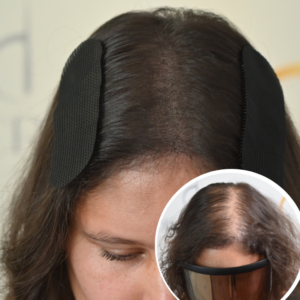 Scalp Micropigmentation Orlando