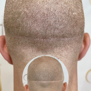 Scalp Micropigmentation Orlando | SMP Near Me