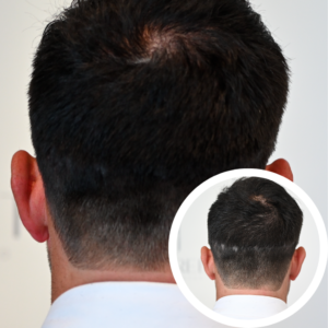 Scalp Micropigmentation Orlando | Scalp Micropigmentation Near Me