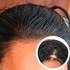 SMP In Orlando | Scalp Micropigmentation | Discreet Cosmetic Studios