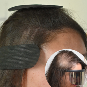 Scalp Micropigmentation SMP