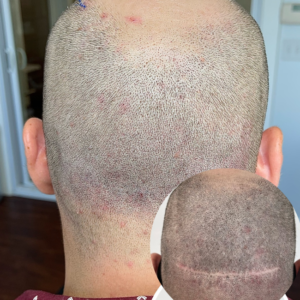 Hair Transplant Scar Camouflage