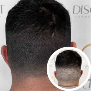 Scalp Micropigmentation Orlando | Scalp Micropigmentation Cost