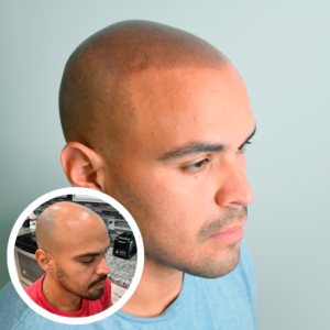 Scalp Micropigmentation Near Me