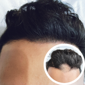 SMP Near Me | Scalp Micropigmentation Cost