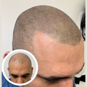 Scalp Micropigmentation Near Me