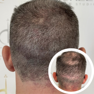 Scalp Micropigmentation Near Me