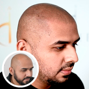 Scalp Micropigmentation Near Me | Scalp Micropigmentation Orlando