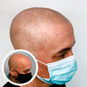 Scalp Micropigmentation Near Me | Discreet Cosmetic Studios