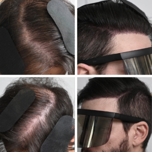 Scalp Micropigmentation SMP | SMP Near Me