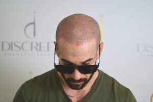 What Is Scalp Micropigmentation