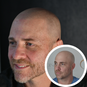 Scalp Micropigmentation