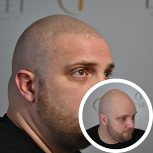 Scalp Micropigmentation Near Me | Discreet Cosmetic Studios